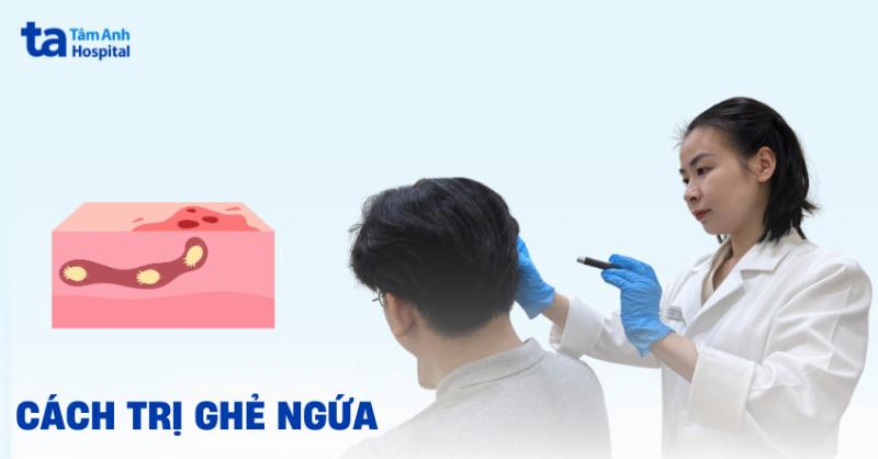 Sơ đồ minh họa vòng đời của ve Sarcoptes scabiei, từ trứng đến ve trưởng thành, giải thích lý do cần điều trị lâu dài trong cách trị xà mâu cho chó