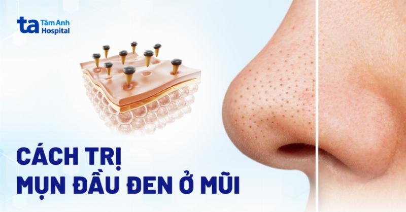 Vệ sinh nhẹ nhàng vùng cằm mèo bằng khăn ẩm giúp loại bỏ đốm đen ban đầu.