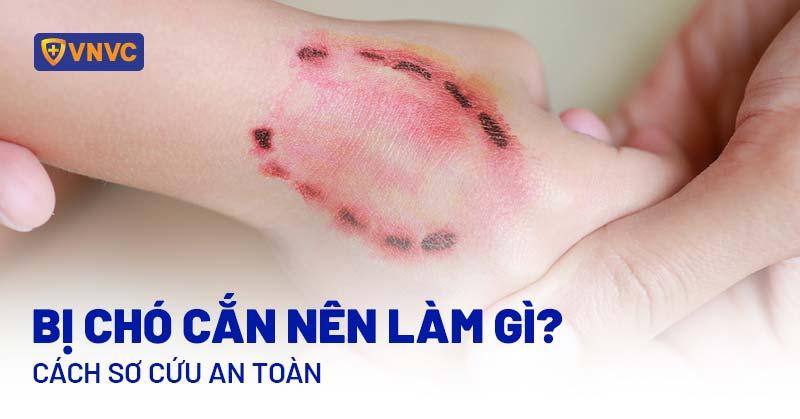 Xử lý khi bị chó dại cắn: Rửa vết thương và đến cơ sở y tế