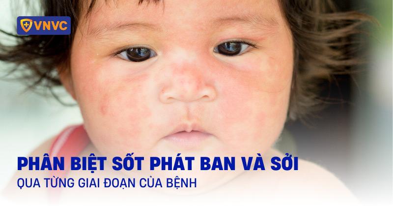 Hinh anh cho bi noi man do o bung, dau hieu ban dau