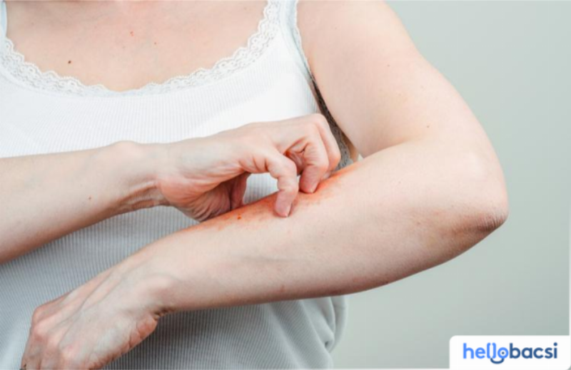 Hình ảnh bọ chét mèo đang cắn da, làm rõ thắc mắc rận mèo có lây sang người không và cơ chế tấn công