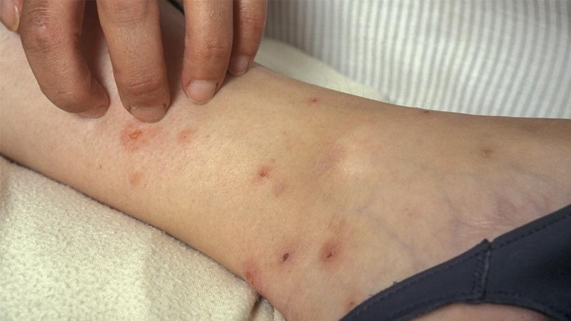 Hình ảnh người bôi kem lên vết cắn bọ chét trên da, hướng dẫn xử lý khi rận mèo có lây sang người không và gây vết cắn