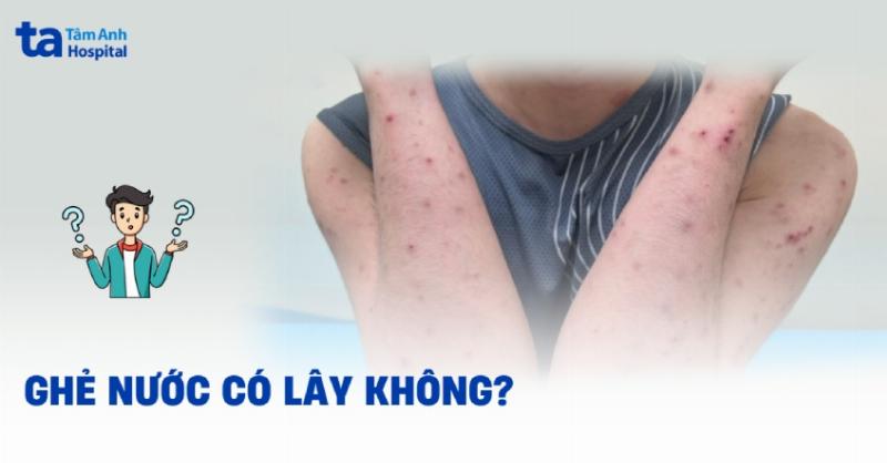 Các vật dụng vệ sinh cá nhân giúp phòng ngừa ghẻ nước